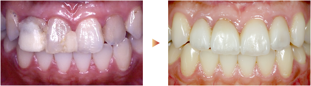 前歯のラミネートベニアとオールセラミック（被せ物）の症例